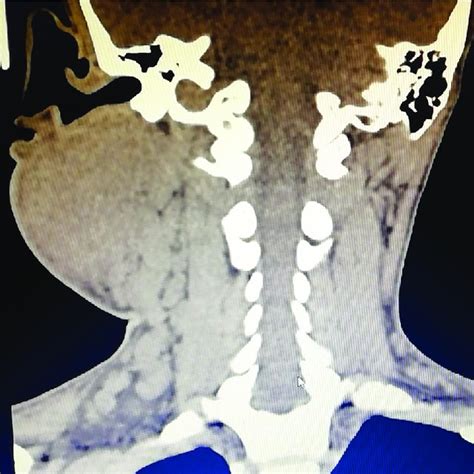 CT neck showed ill-defined large heterogenous enhancing soft tissue ...