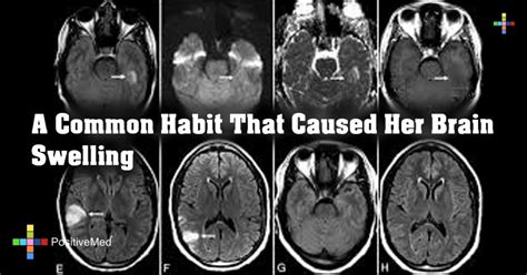 A Common Habit That Caused Her Brain Swelling - PositiveMed