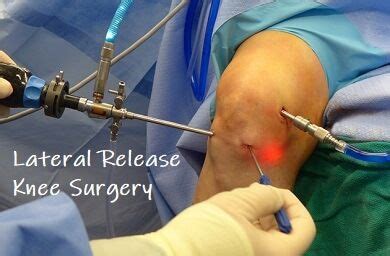 Lateral release knee surgery realigns the patella by releasing tight ...