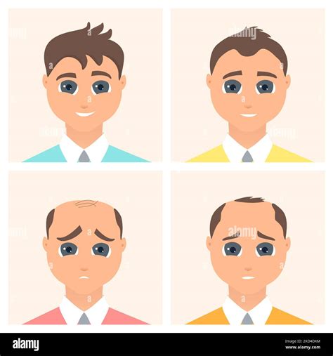 Male alopecia stages, illustration Stock Photo - Alamy