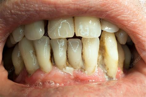 Teeth covered with plaque and tartar - Stock Image C034/2621 - Science ...