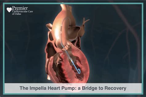 Impella Heart Pump in Cardiogenic Shock | Premier Cardiovascular