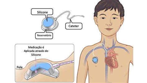 Port-A-Cath - O que é e Como Utilizar | Instituto Barão Vascular