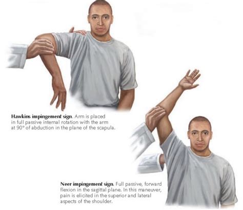 Rotator Cuff Tear Signs And Symptoms Diagnosis And Treatment Options ...