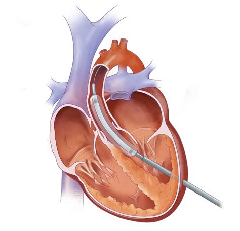 Fetal Balloon Aortic Valvuloplasty for Critical Aortic Stenosis ...