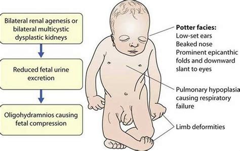 These are the symptoms of Potter Sequence syndrome - MEDizzy