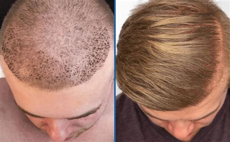 Hair transplant | The best and newest Hair transplant method | Cost: $890