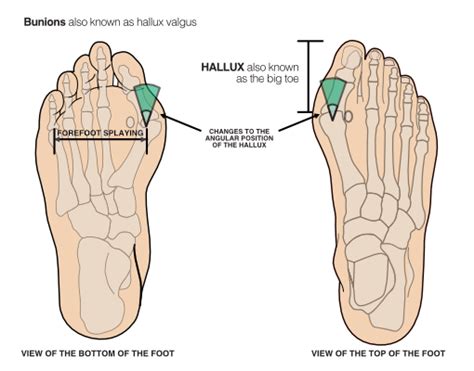 Hallux Valgus (Bunions) | NHS Lanarkshire