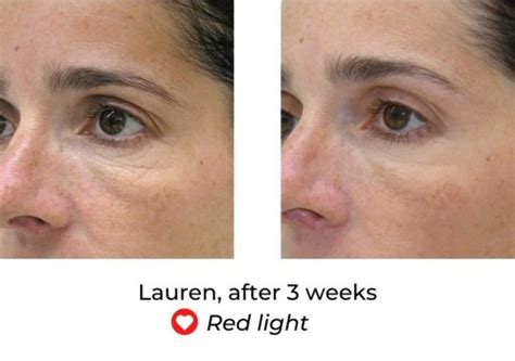 LED Face Mask Before And After - MyLEDtherapy - LED Light Therapy ...