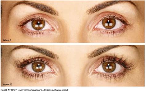 Latisse Eyelash Enhancement | Advanced Skin Therapy of Smokey Point