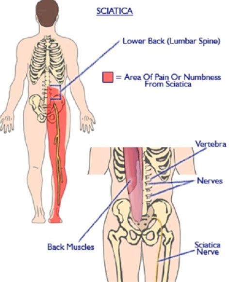 14 Causes of Lower Right Back Pain with Treatments