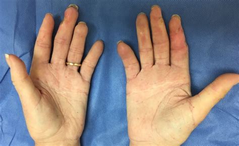 SCLERODERMA (SYSTEMIC SCLEROSIS, CREST) | Hand Surgery Source