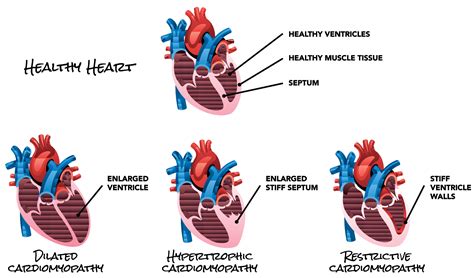 Restrictive Cardiomyopathy