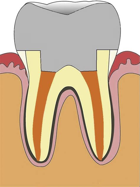 Endocrowns: A systematic review - Journal of Prosthetic Dentistry