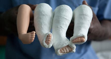 Club Foot (Talipes Equinovarus) - Ankle, Foot and Orthotic Centre