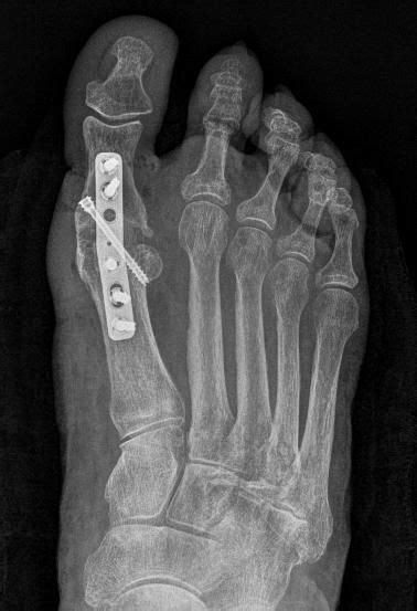 Hallux Rigidus X Ray