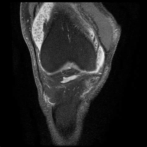 Radiology Cases: Synovial Osteochondromatosis