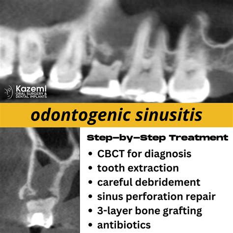 treatment for sinus perforation from infected tooth | treatment for ...