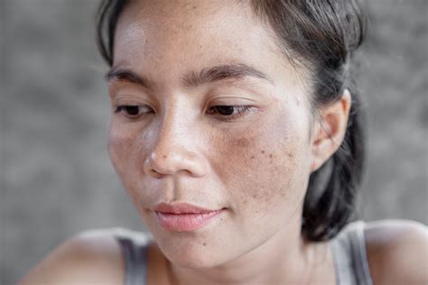 Melasma 101: What You Need to Know - Buckhead Dermatology