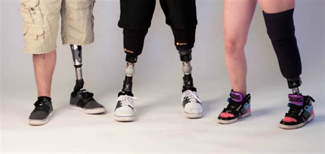 What Is Life Like with a Lower Limb Prosthesis?