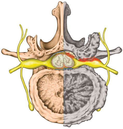 Foraminal Narrowing in Frisco | American Neurospine Institute