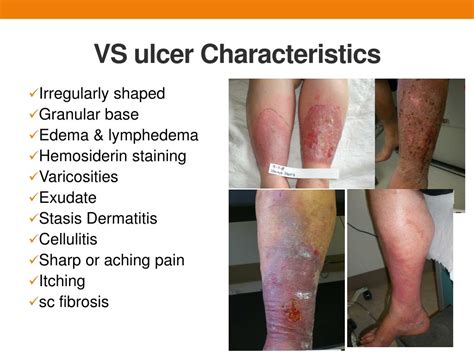 Ppt Venous Ulcer Symptoms Causes And Treatment Powerpoint – NBKomputer