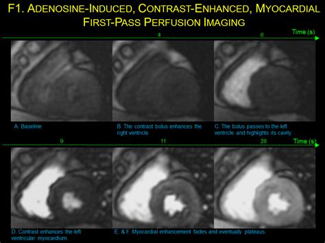 Slide1 - Cardiac MRI