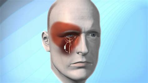 Pulsante Microstimulator for Cluster Headache - YouTube