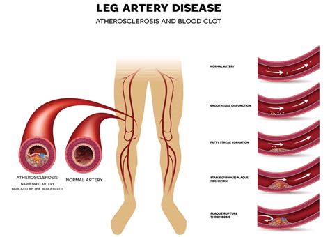 What Causes Vascular Disease in the Legs? | Miami Vein Center