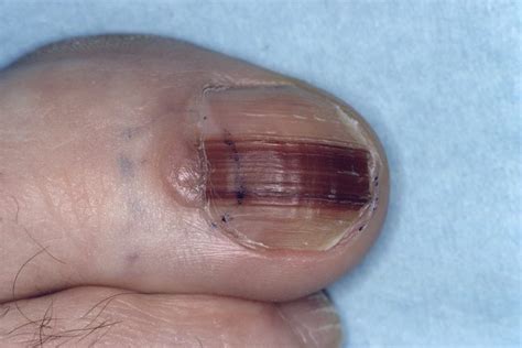 Early Identification of Nail Unit Melanoma Leads to Good Prognosis ...