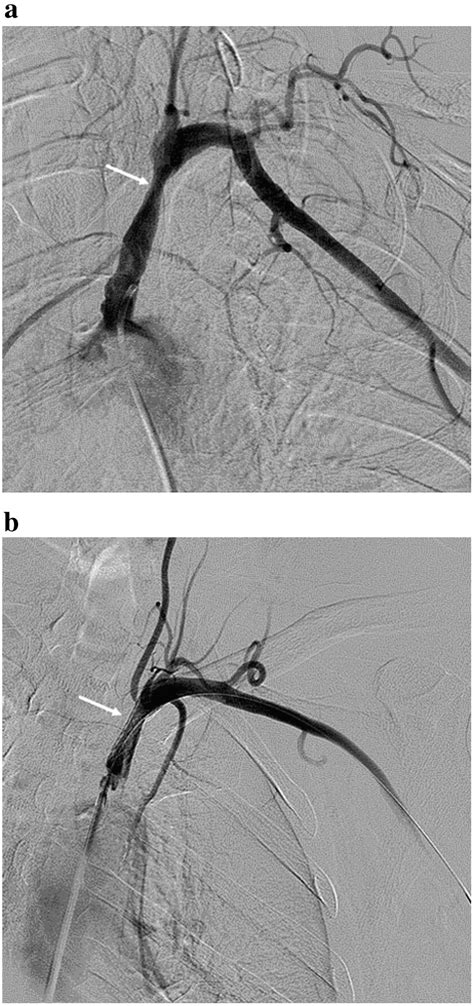 Prevalence and treatment of proximal left subclavian artery stenosis in patients referred for ...