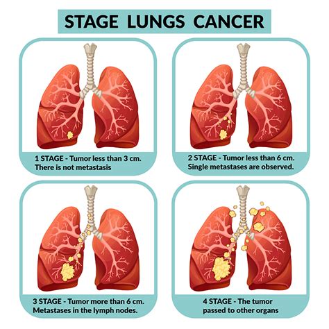 Lung Cancer- Causes, Symptoms and Treatment in Bangalore