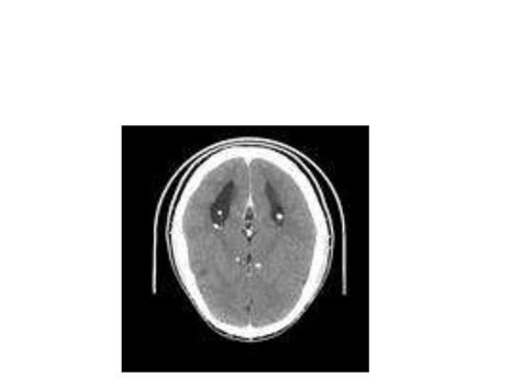 Neurocutaneous syndromes