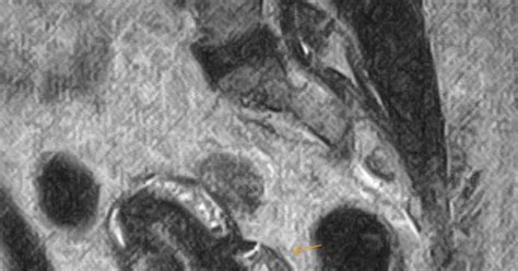 Adenomyosis-MRI - Sumer's Radiology Blog