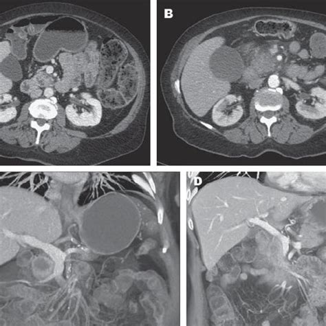 ERCP demonstrating a classic “double duct” sign. The arrow shows tumor ...