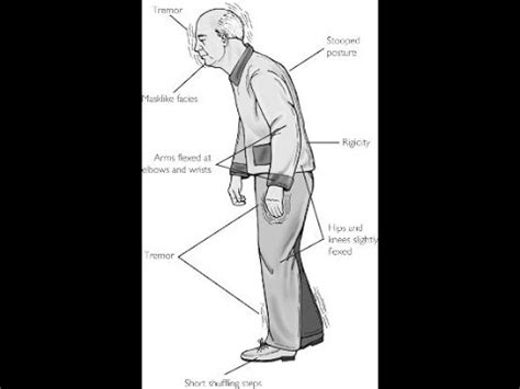 Extrapyramidal Symptoms - YouTube