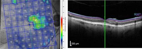 Add OCT to ICD-10 Glaucoma Grading, Experts Argue