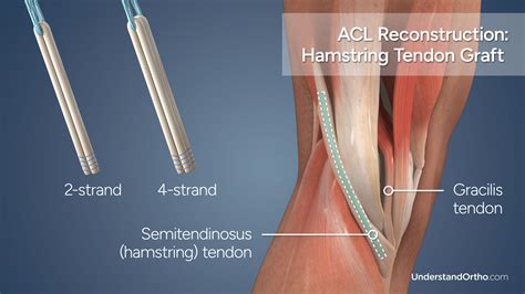 Torn ACL Reconstruction (Hamstring Graft) – UnderstandOrtho™