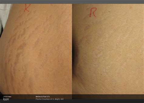 Laser Stretch Marks Rockville, MD - Olsen Aesthetics