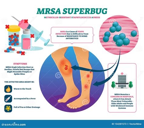 MRSA Methicillin-Resistant Staphylococcus Aureus Infection Royalty-Free ...