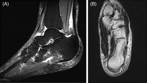 C,D, MRI images demonstrating non‐specific oedema within the Kager fat ...