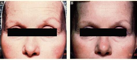 Six months of daily 0.01% tretinoin, before and after. Study link in ...