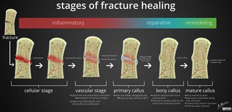 Fracture Types And Stages Of Healing All Fractures Can Be Broadly | My XXX Hot Girl
