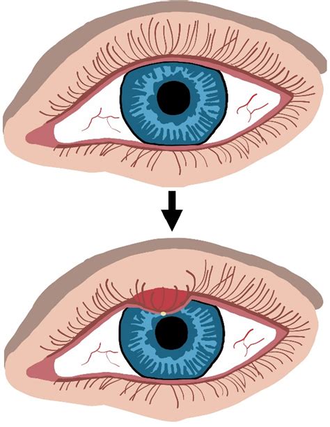 Chalazion vs Hordeolum