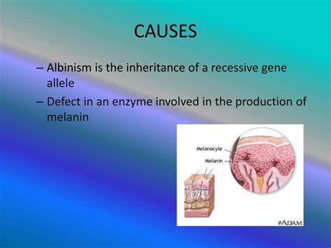 PPT - ALBINISM PowerPoint Presentation, free download - ID:2874677