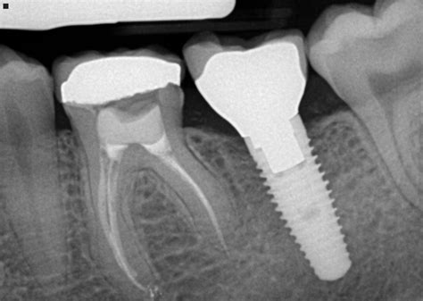 implantxray – Westway Dental