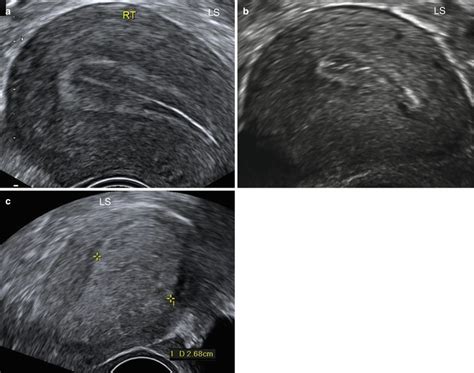 Ultrasound Evaluation of Endometrium | Obgyn Key