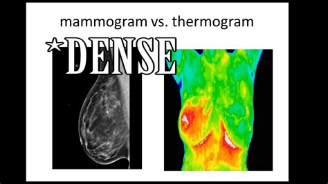 Mammography vs Thermography. Explained - YouTube