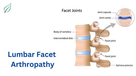 Expert Lumbar Facet Joint Arthropathy Treatment - Spinalogy Clinic | Best Back Pain, Slip Disc ...