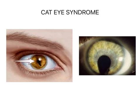 What is Cat-Eye Syndrome -- here's what the science says